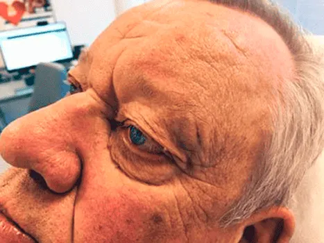 Luomen poisto after example 1