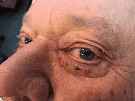 Luomen poisto before example 1