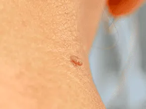 Luomen poisto before example 3