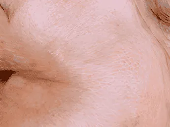 Luomen poisto after example 6