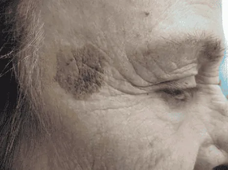 Luomen poisto before example 8