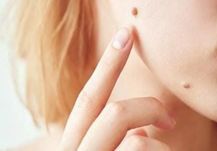Moles