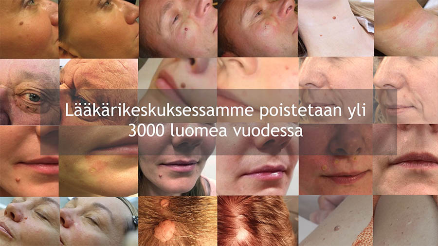 luomen-poisto