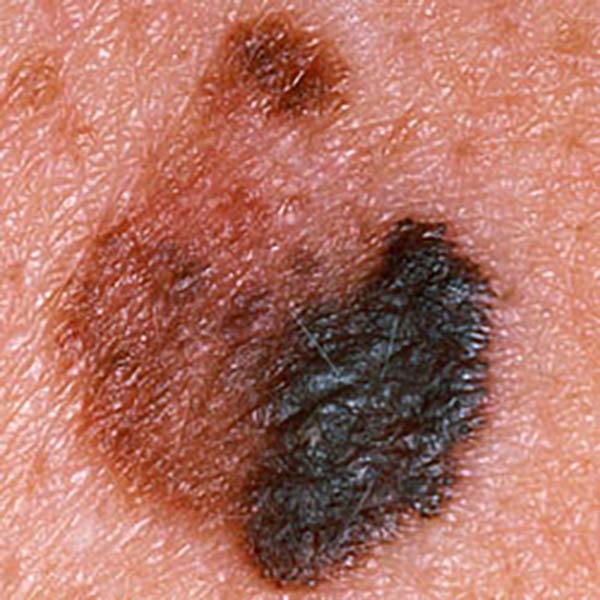 angiokerat3 image angiokerat3 Luomien kuvagalleria | MedFin