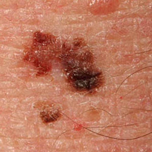 angiokerat3 image angiokerat3 Luomien kuvagalleria | MedFin