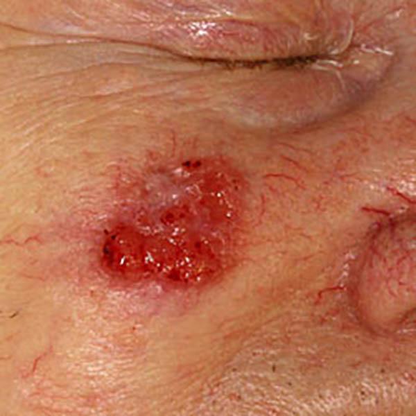 angiokerat3 image angiokerat3 Luomien kuvagalleria | MedFin