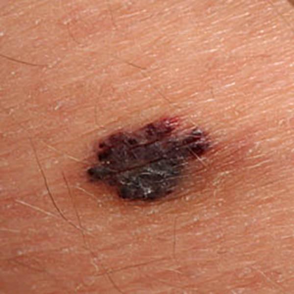 angiokerat3 image angiokerat3 Luomien kuvagalleria | MedFin