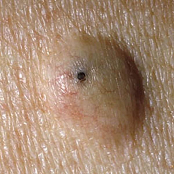angiokerat3 image angiokerat3 Luomien kuvagalleria | MedFin