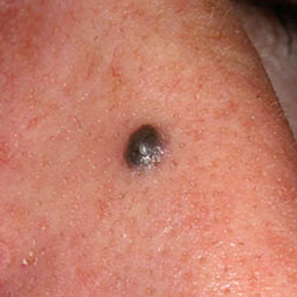 angiokerat3 image angiokerat3 Luomien kuvagalleria | MedFin