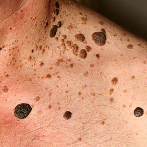 angiokerat3 image angiokerat3 Luomien kuvagalleria | MedFin