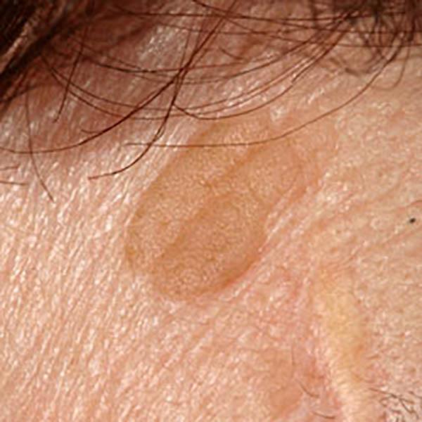 angiokerat3 image angiokerat3 Luomien kuvagalleria | MedFin