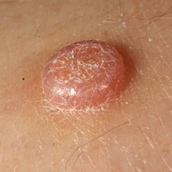 angiokerat3 image angiokerat3 Luomien kuvagalleria | MedFin