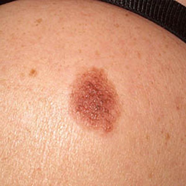 angiokerat3 image angiokerat3 Luomien kuvagalleria | MedFin
