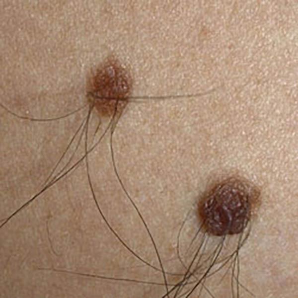angiokerat3 image angiokerat3 Luomien kuvagalleria | MedFin