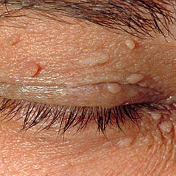 angiokerat3 image angiokerat3 Luomien kuvagalleria | MedFin