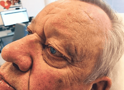 Mole removal after example 1