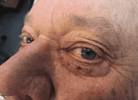 Mole removal before example 1